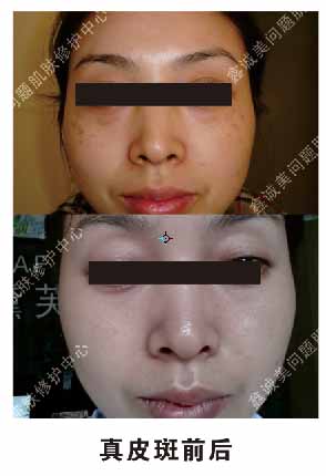 祛痘祛斑 祛痘祛斑