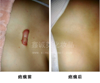 祛斑之后也不能掉以輕心，成都神奇魔斑告訴您有這些注意事項(xiàng)